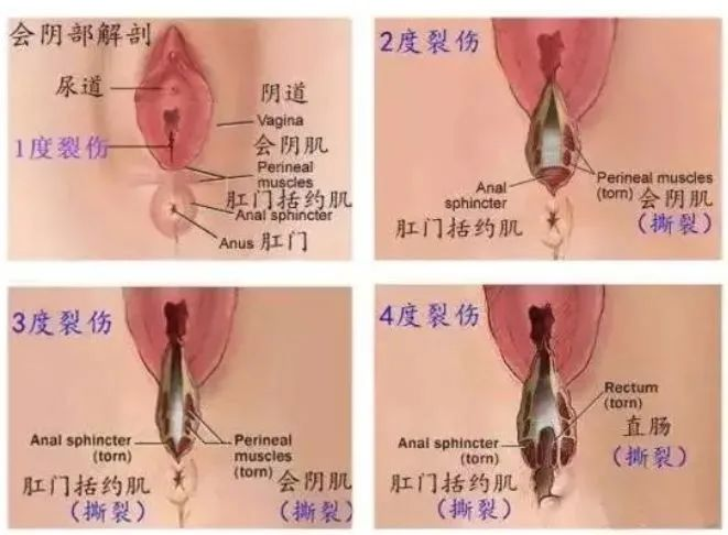 会阴侧切和撕裂，哪个对产后夫妻生活影响更大？